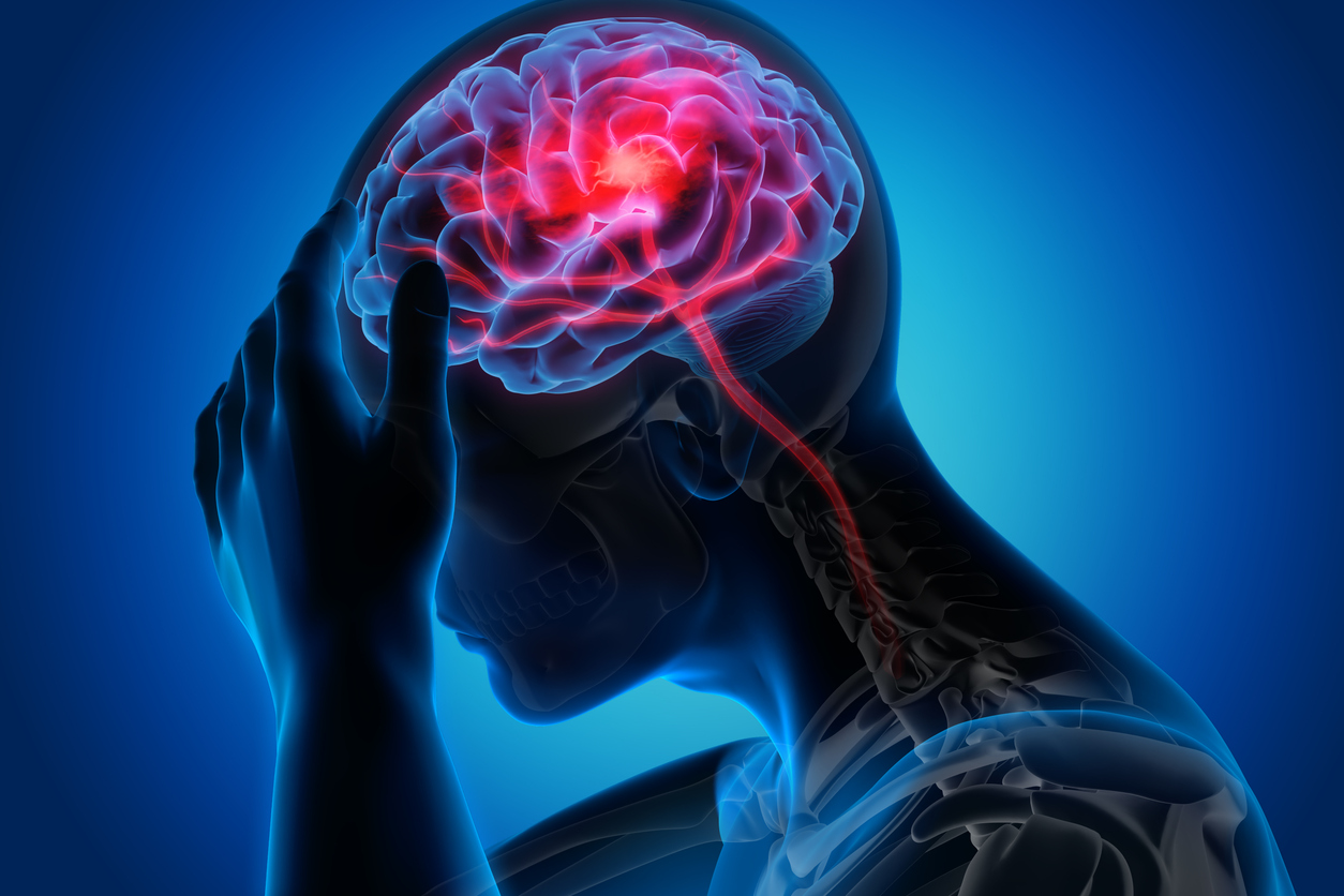 Migraines vs Headaches: Understanding the Differences